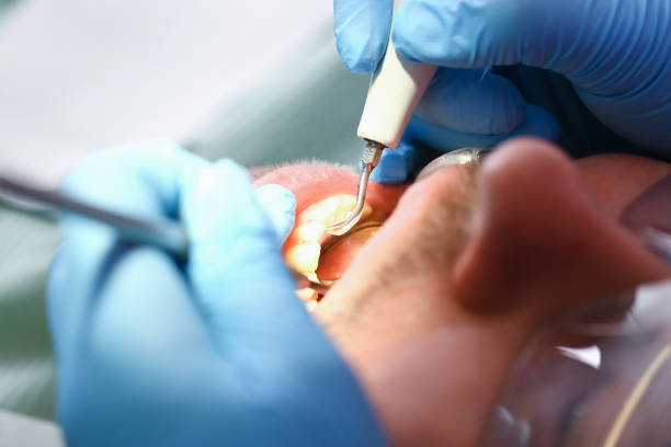 Best Urgent Care for Lost Fillings or Crowns in Berwick, PA