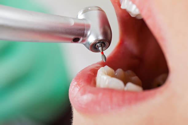 Best Emergency Tooth Extraction in Berwick, PA